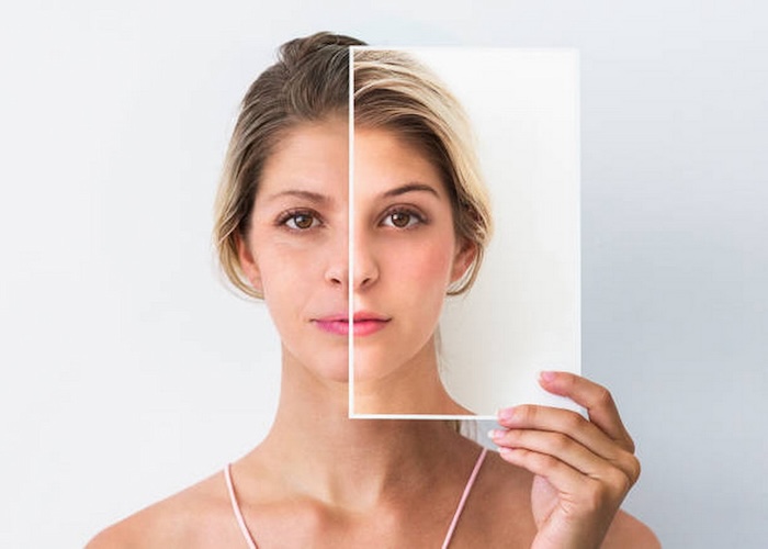 Thẩm mỹ căng chỉ collagen