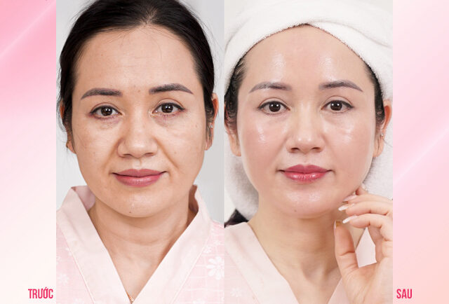 Da săn chắc hơn sau điều trị Ultherapy