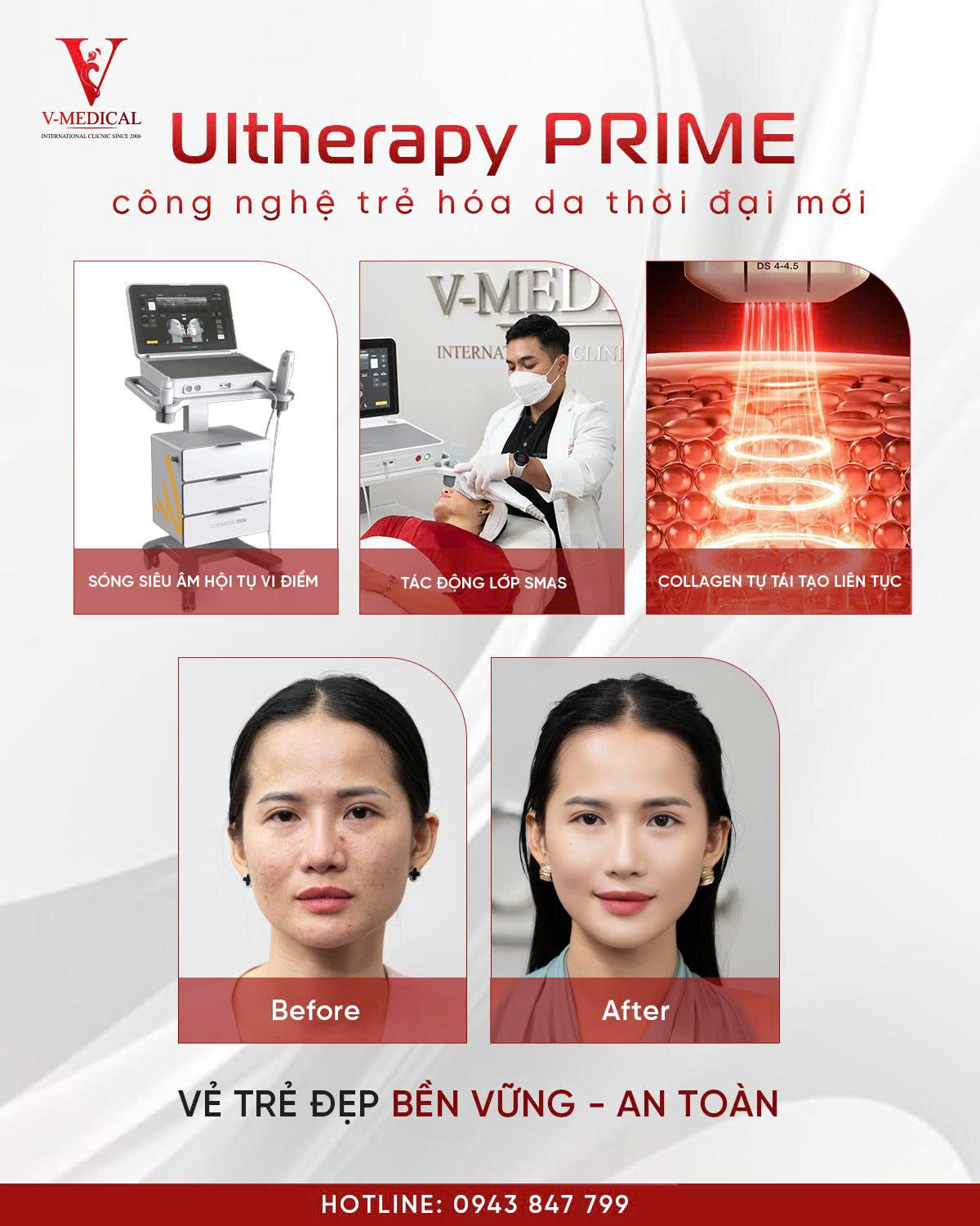 Khám phá 5 ưu điểm của Ultherapy