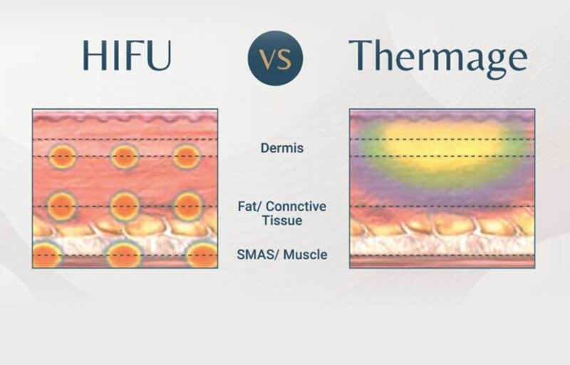so-sanh-cong-nghe-hifu-va-thermage