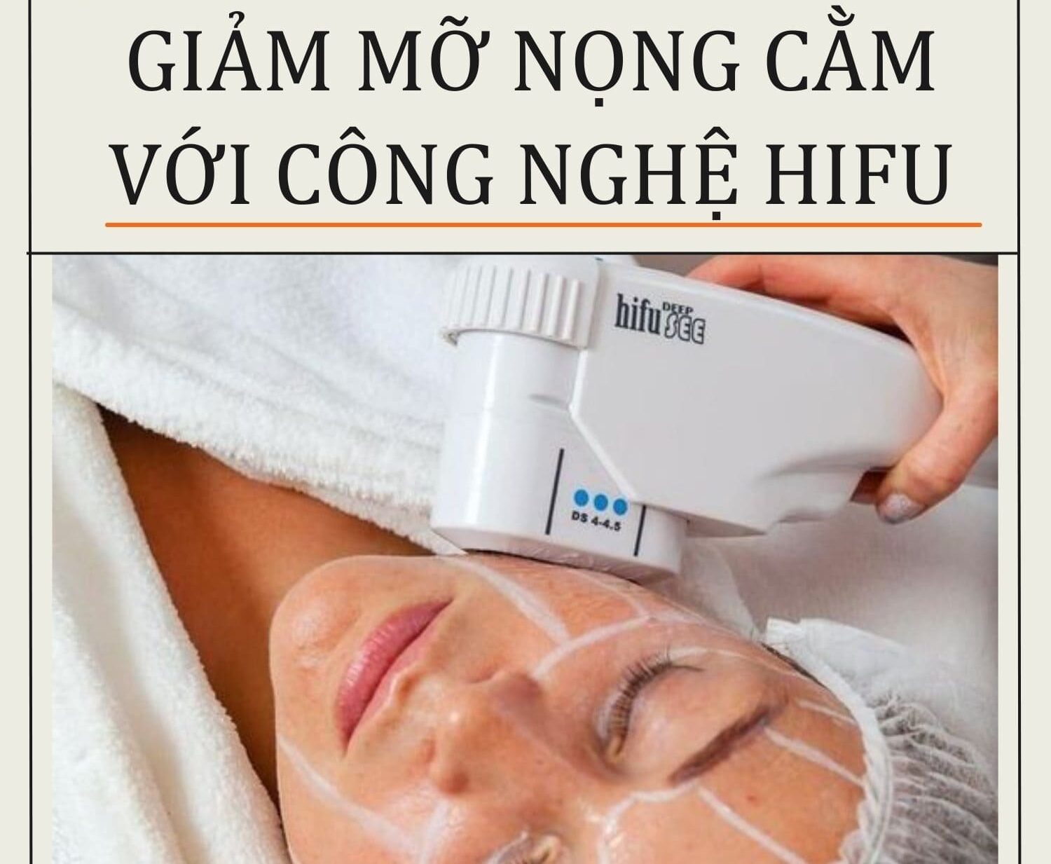 xoá nọng cằm với công nghệ Hifu