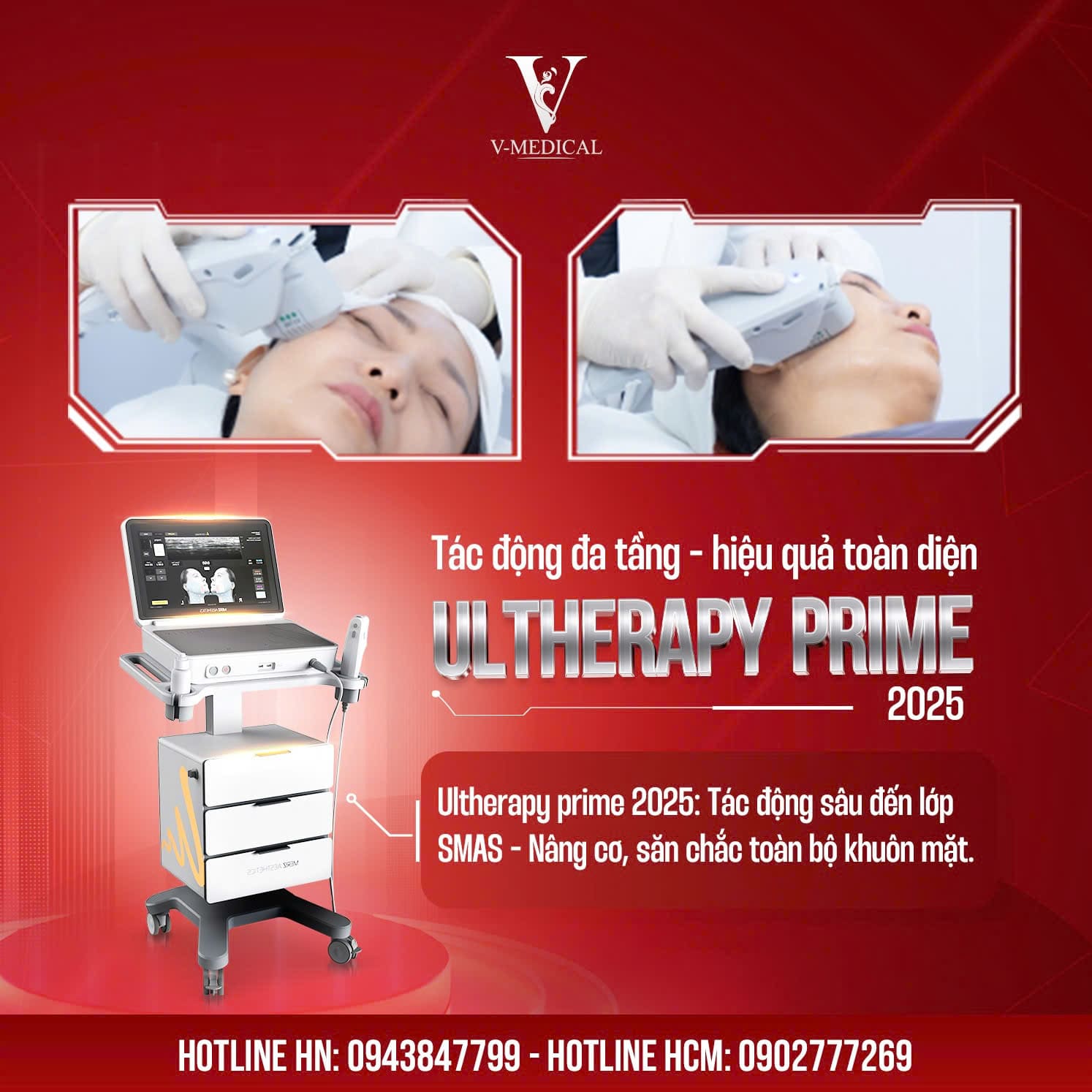 Quy trình Ultherapy Prime