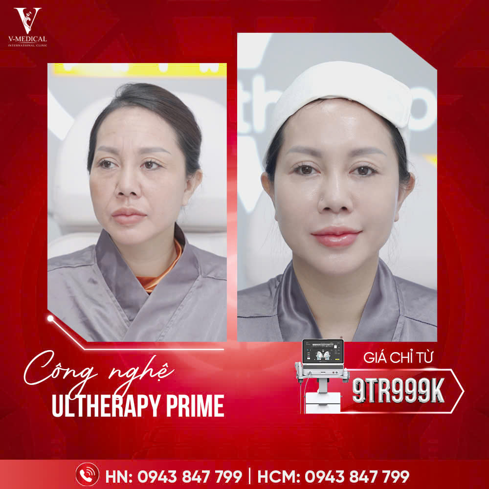Giá nâng cơ Ultherapy Prime tại V-Medical