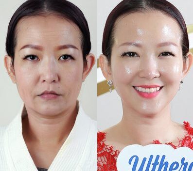 Kết quả trước và sau khi căng da nâng cơ Ultherapy