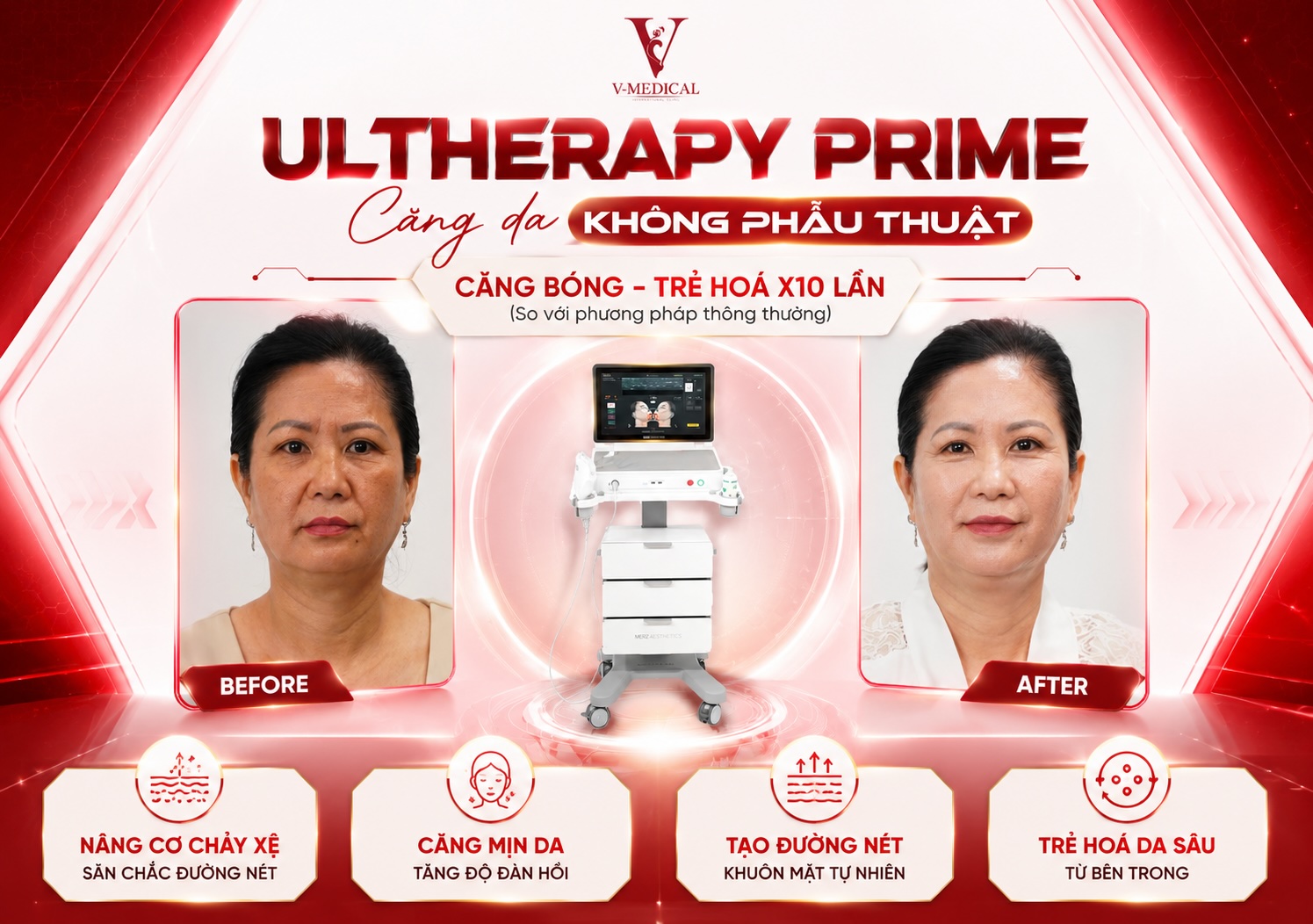 Làm ultherapy có hiệu quả không Làm ultherapy có hiệu quả không