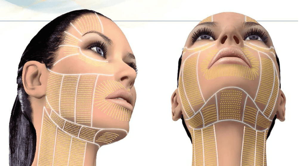 Các vùng có thể điều trị của Quy trình Ultherapy Prime