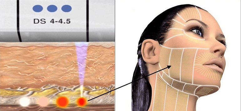 Làm công nghệ Ultherapy Prime ở đâu uy tín tốt