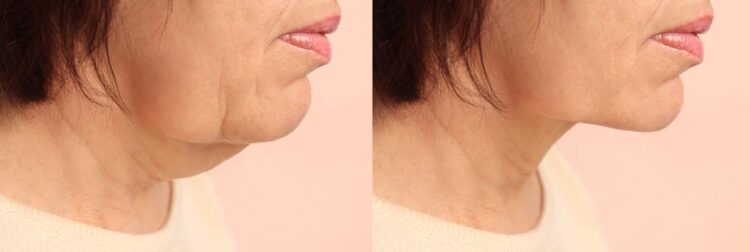 Hiệu quả nâng cơ của công nghệ Ultherapy Prime