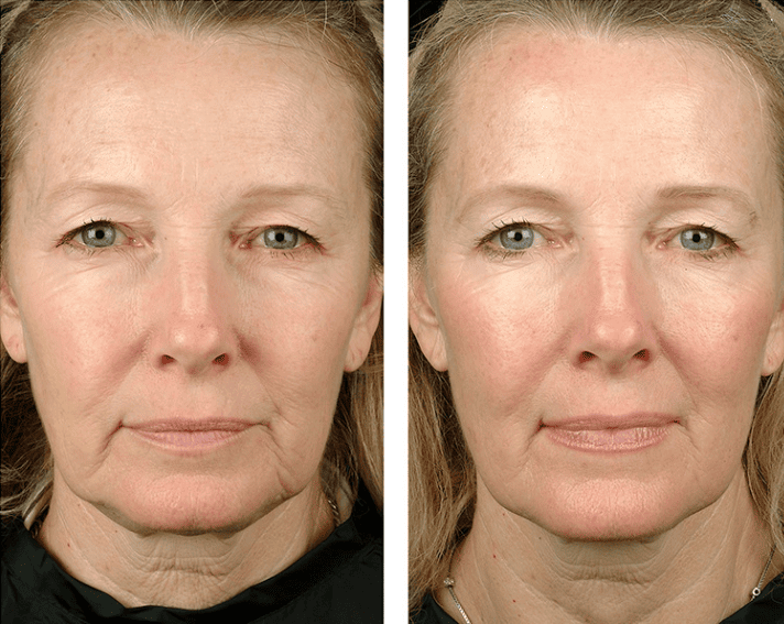 Khác biệt hiệu quả của Ultherapy Prime và Thermage