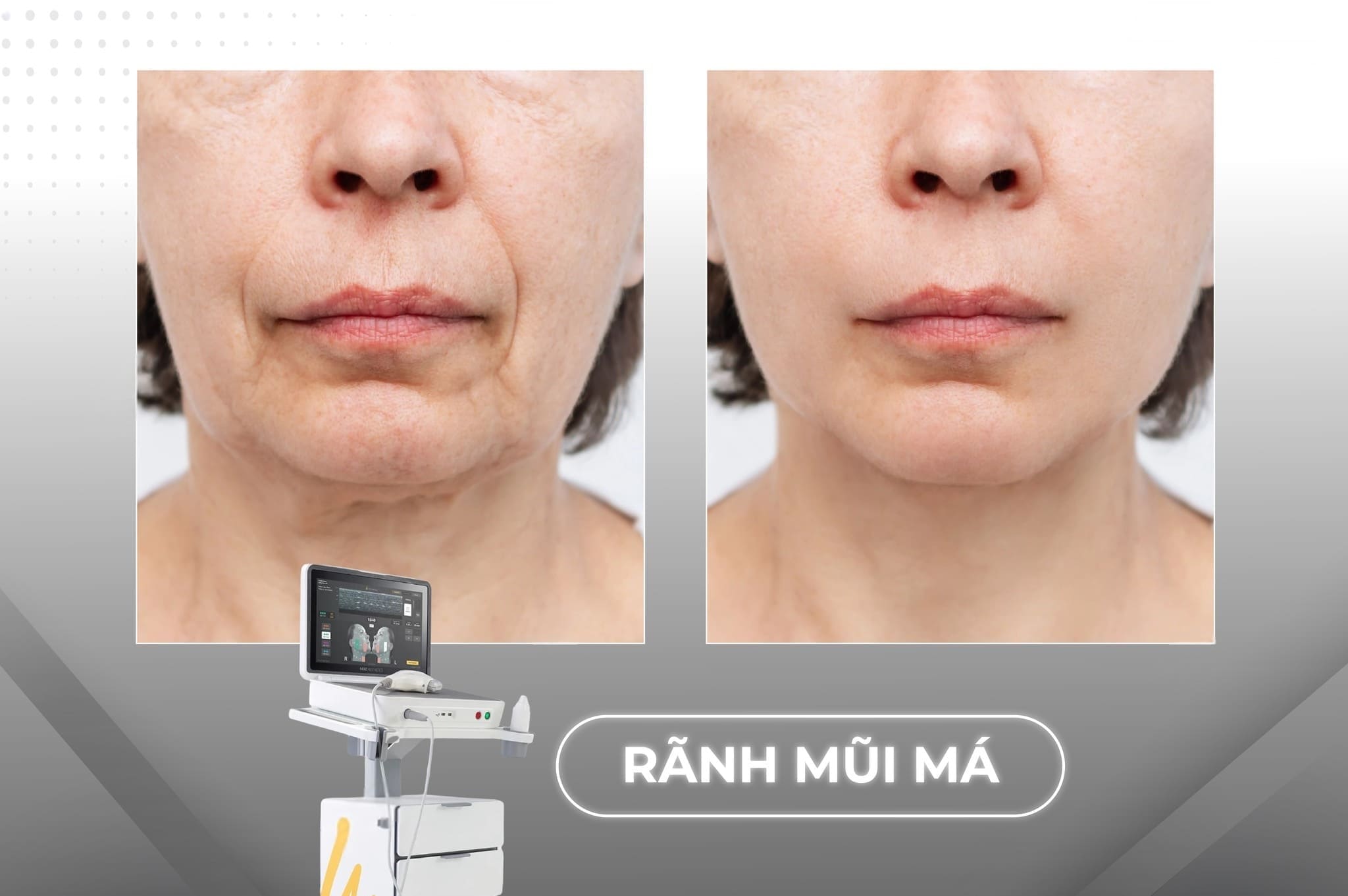 Trẻ hóa da Ultherapy Prime giúp giảm nếp nhăn