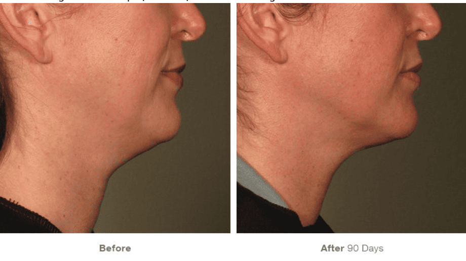 Trước và sau quy trình Ultherapy Prime