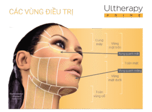 Các vùng nâng cơ Ultherapy prime hiệu quả