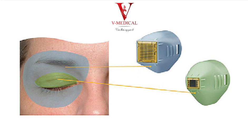 Cơ chế hoạt động của Thermage vùng mắt
