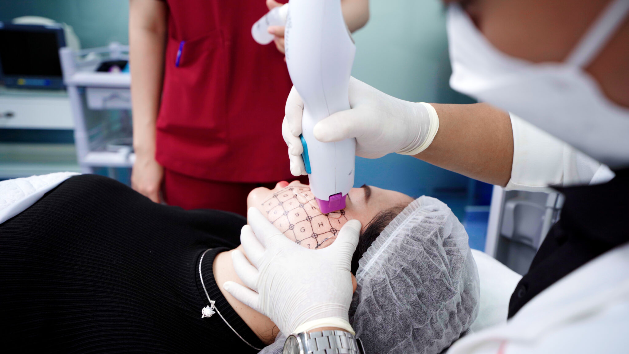Điều trị Thermage vùng mắt tại V-Medical