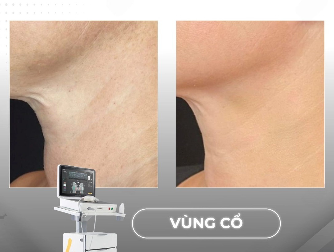 Hiệu quả của Ultherapy Prime trong việc trẻ hóa vùng cổ
