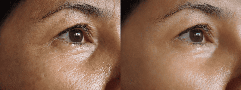 Hiệu quả của Ultherapy Prime trong việc xóa nhăn mắt