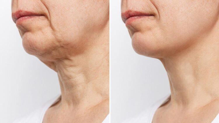 Hiệu quả của công nghệ Ultherapy Prime nâng cơ