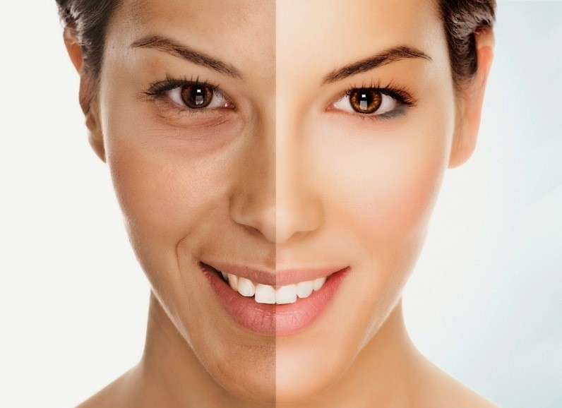 Làn da thiếu sức sống cần căng da bằng Ultherapy Prime