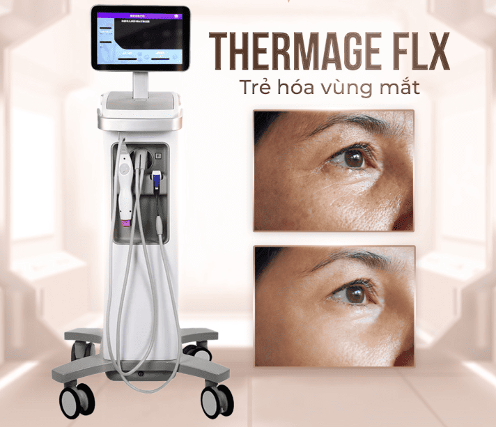 Thermage vùng mắt giúp trẻ hóa