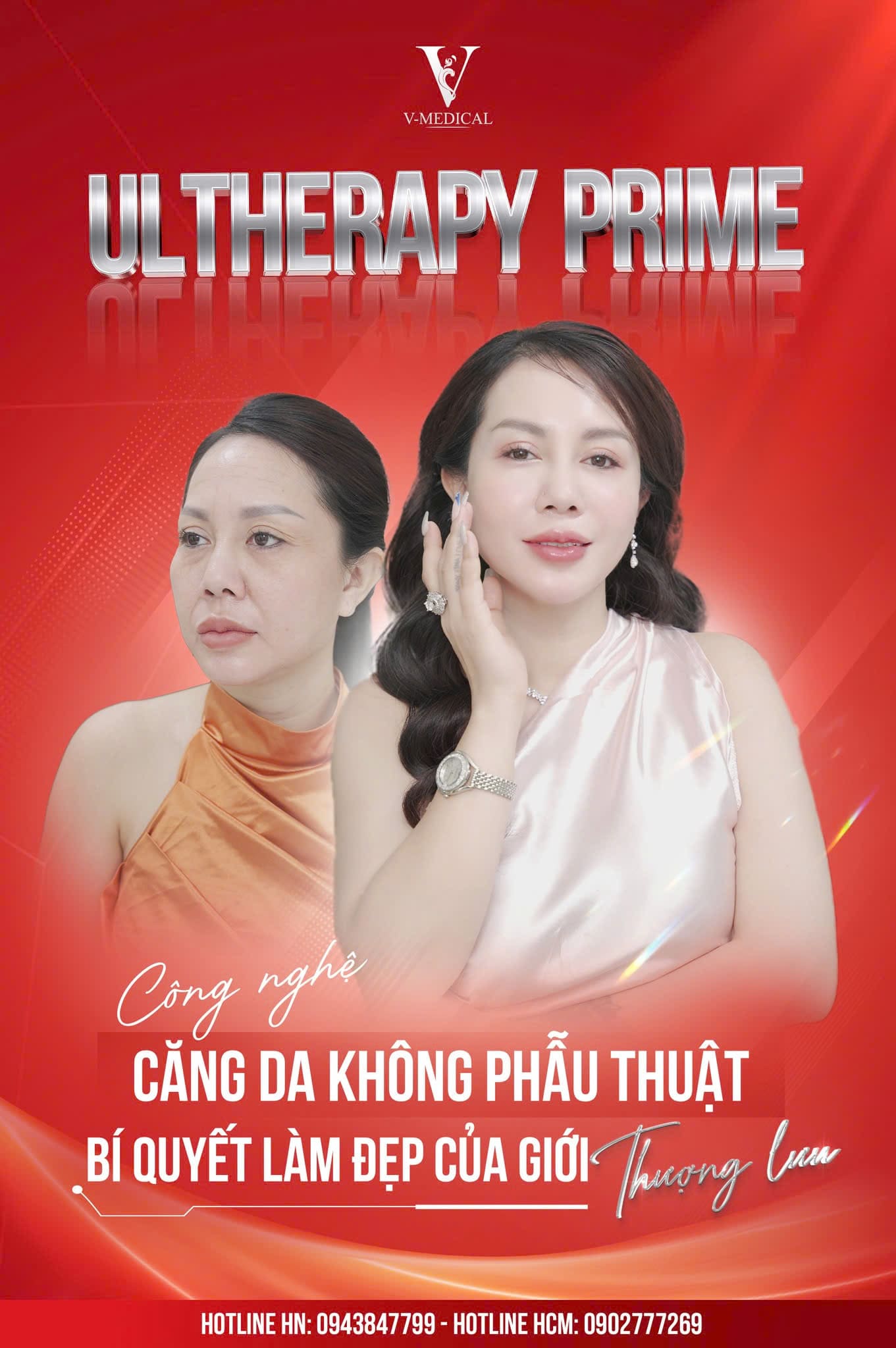 Ultherapy Prime nâng cơ ở Viện thẩm mỹ V-Medical