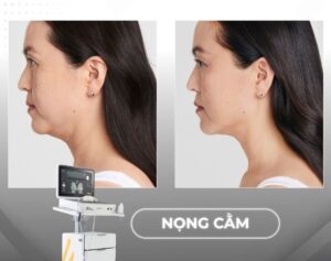 Vì sao nên giảm nọng cằm với Ultherapy prime