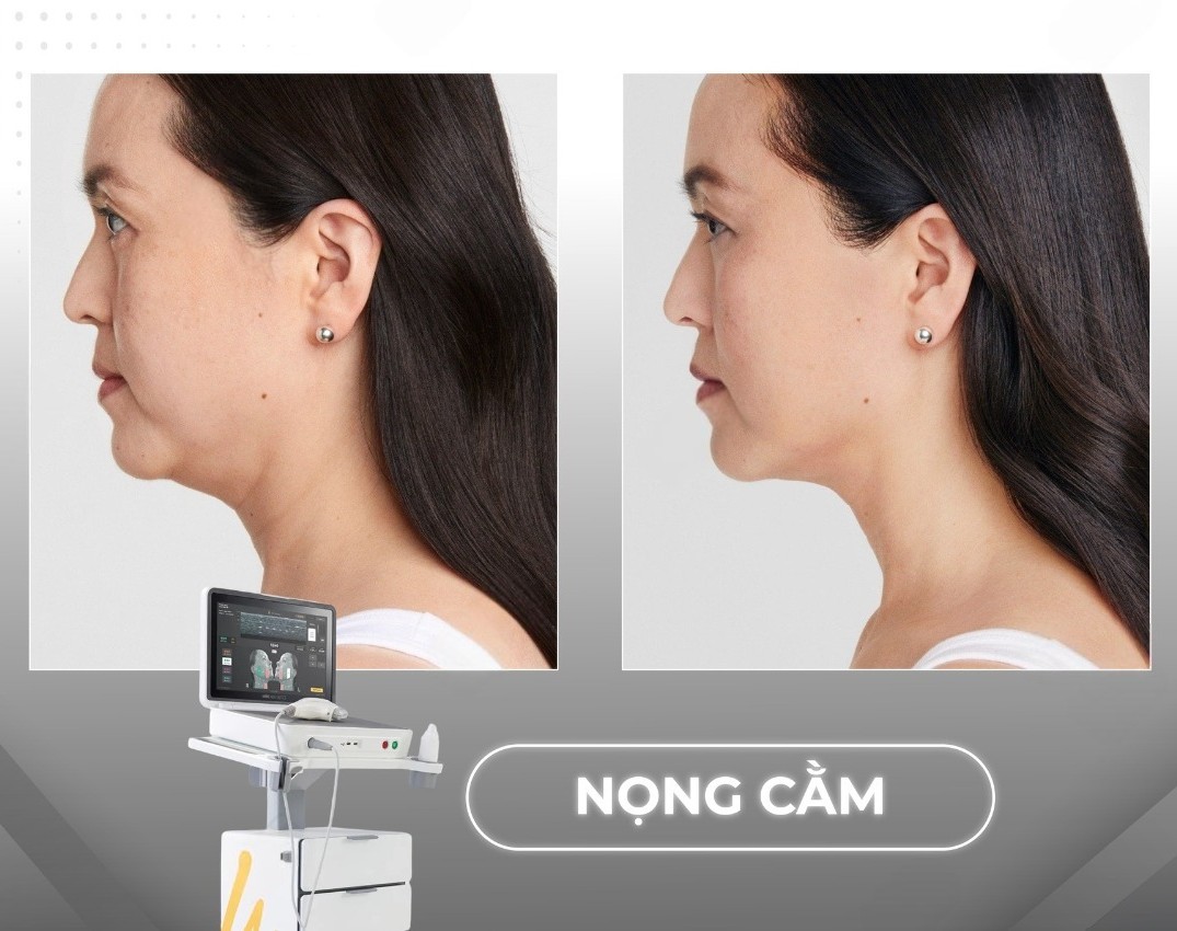 Vì sao nên giảm nọng cằm với Ultherapy prime