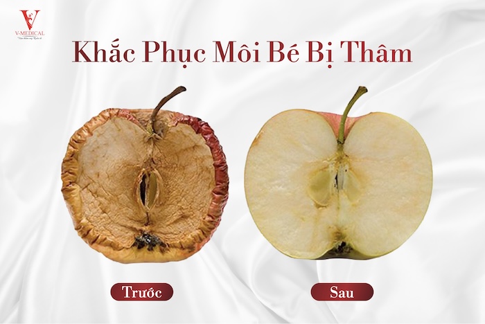 Cách làm hồng vùng kín tại nhà Cách làm hồng vùng kín tại nhà