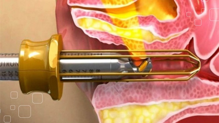 Thu nhỏ vùng kín bằng laser