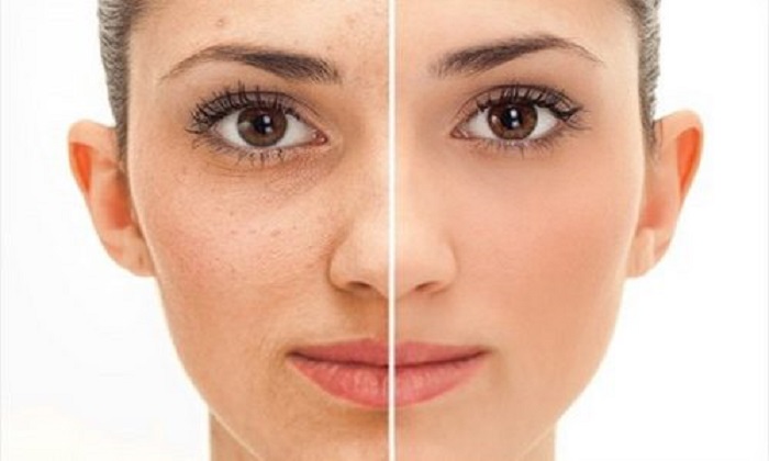 Bọng mắt có nếp nhăn Bọng mắt có nếp nhăn