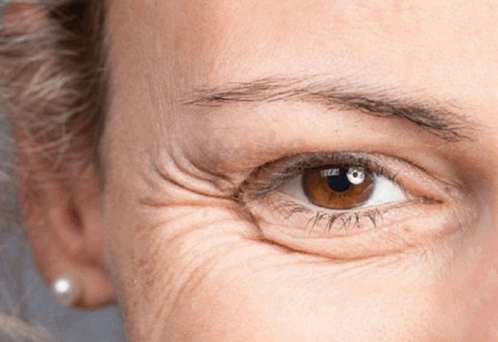 Cách làm giảm nếp nhăn ở bọng mắt Cách làm giảm nếp nhăn ở bọng mắt