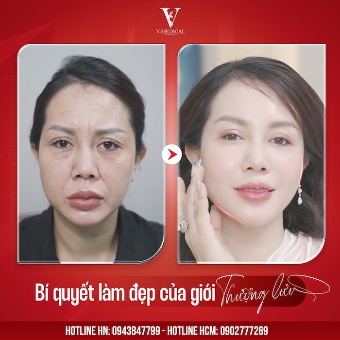 Cách tập yoga trẻ hóa làn da