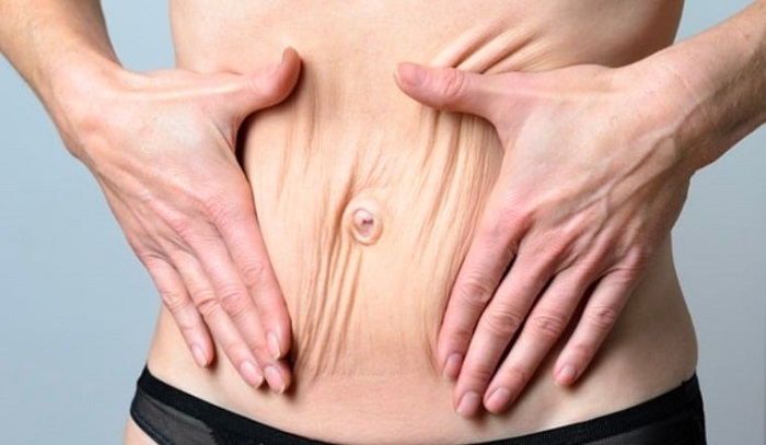 Cách xóa nếp nhăn ở bụng