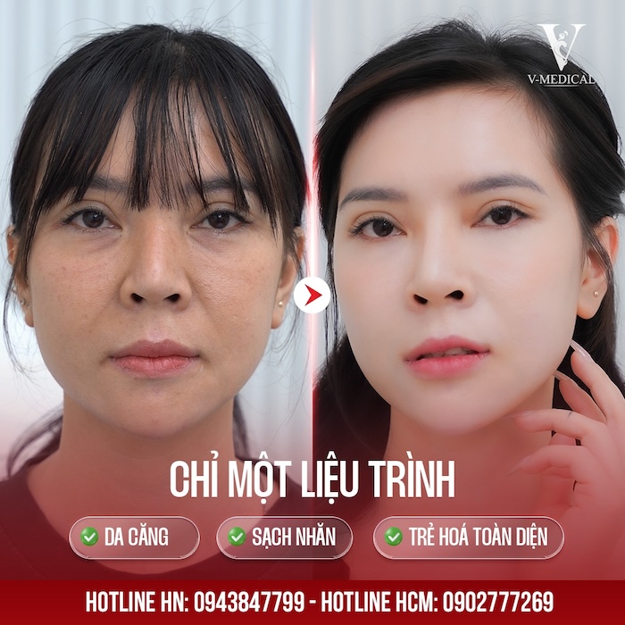 Căng chỉ xóa rãnh cười