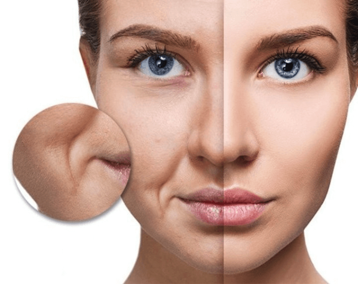 Chữa nếp nhăn khóe miệng