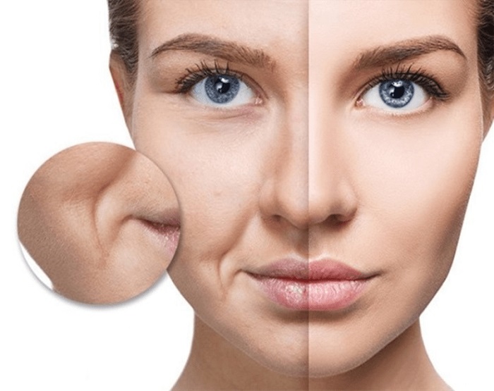 Cơ mặt bị chảy xệ