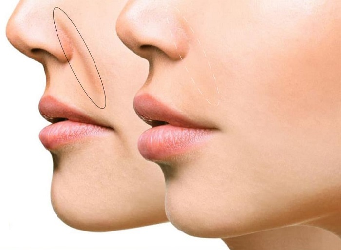 Công nghệ xóa rãnh cười Công nghệ xóa rãnh cười