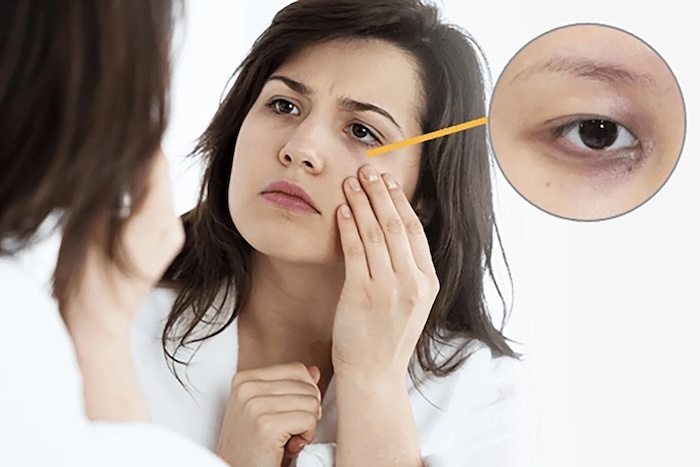 Mẹo chữa nếp nhăn vùng mắt