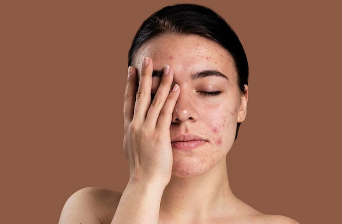Miếng dán xóa nếp nhăn khóe miệng