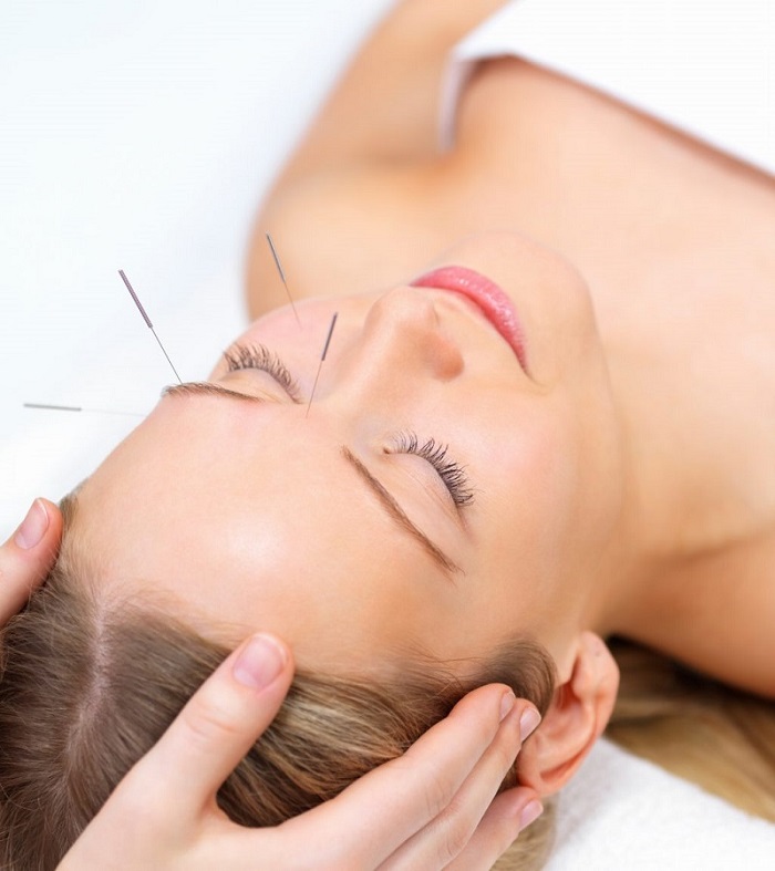 Nâng cơ mặt bằng châm cứu