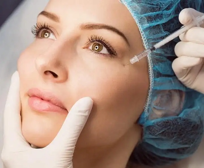 Nâng cơ mặt bằng chỉ collagen