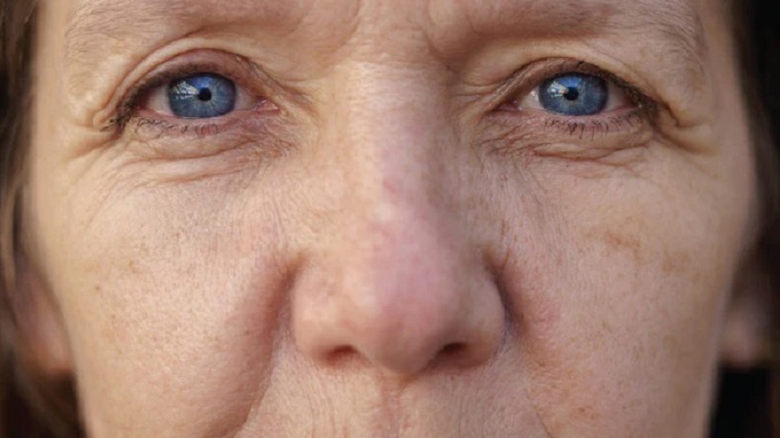 Nếp nhăn bẩm sinh Nếp nhăn bẩm sinh