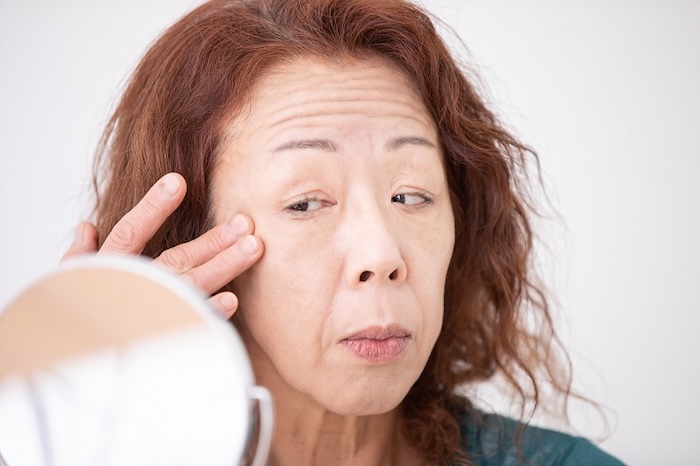 Nếp nhăn gò má