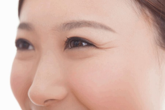 Nếp nhăn ở mắt khi cười