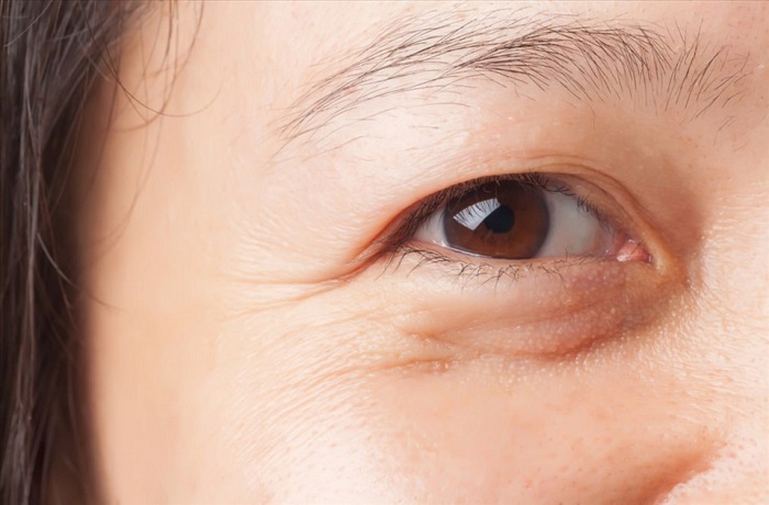 Nếp nhăn ở mắt khi cười