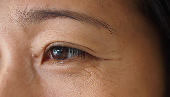 Người có nếp nhăn ở mắt