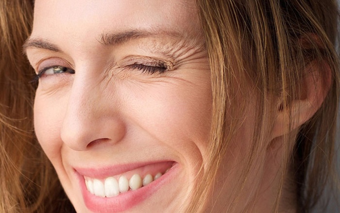 Phẫu thuật xóa nếp nhăn đuôi mắt