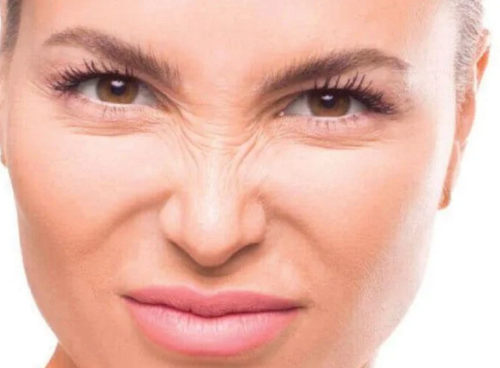 Sống mũi có nếp nhăn Sống mũi có nếp nhăn