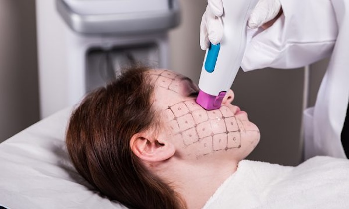 Thermage vùng mắt