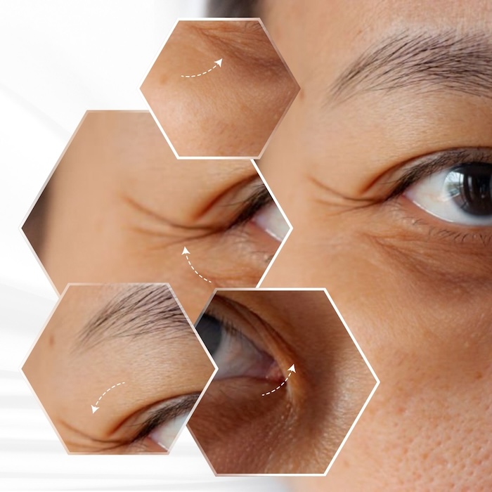 Tiêm trẻ hóa vùng mắt