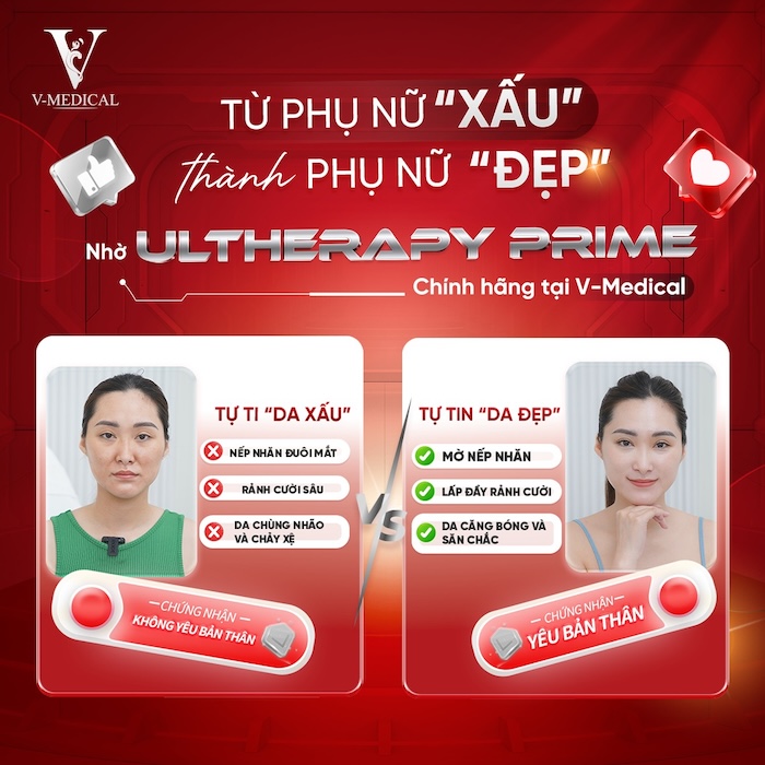 Ultherapy chính hãng